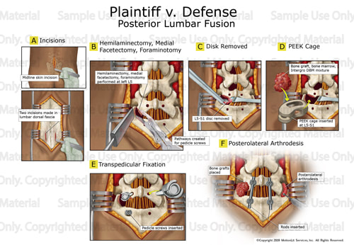 illustration-posterior-lumbar-fusion-001