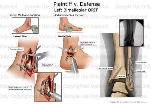 illustration-samples-foot-bimalleolar-orif-001