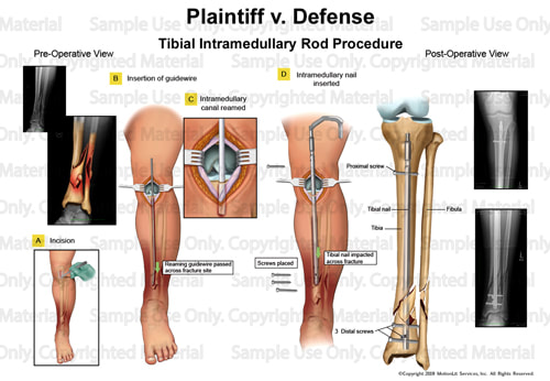 illustration-tibial-intramedullary-rod-procedure-001