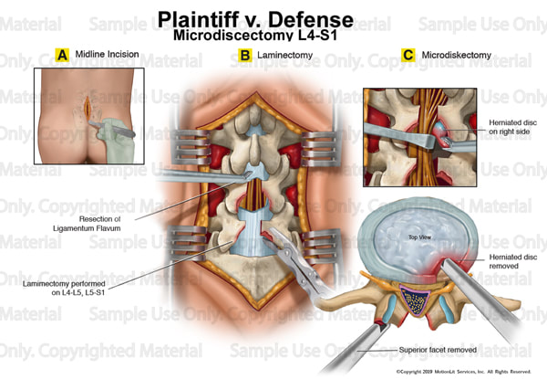 medical-illustration-microdiscectomy-l4-s1-001